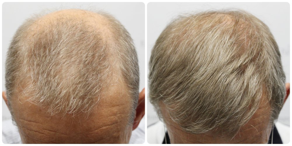 dr-bonaros-hair-transplant-glasgow-result (25).jpg