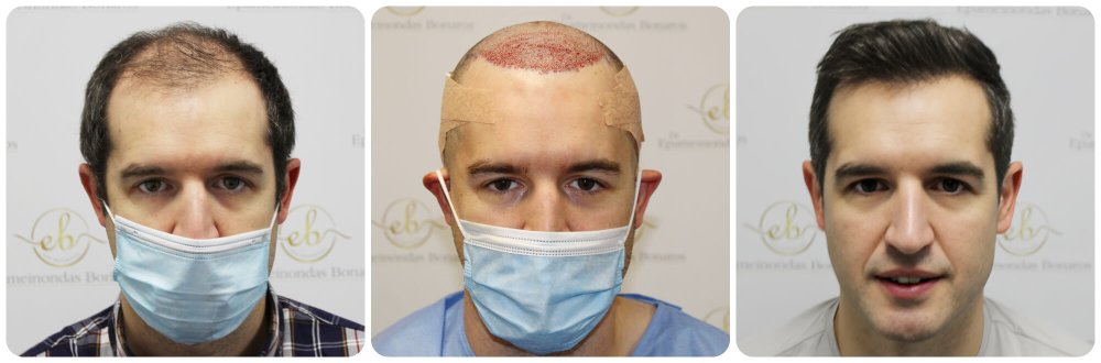dr-bonaros-hair-transplant-glasgow-result (27) (1).jpg