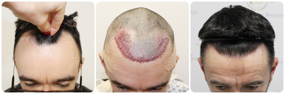 dr-bonaros-hair-transplant-glasgow-result (31) (1).jpg