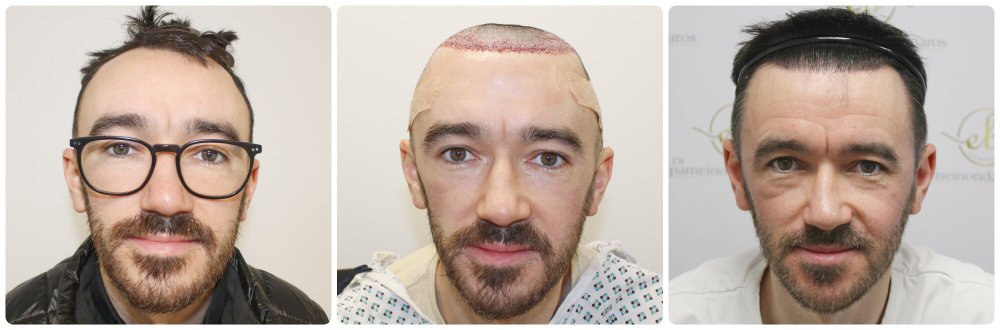 dr-bonaros-hair-transplant-glasgow-result (32) (1).jpg