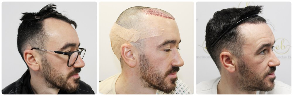 dr-bonaros-hair-transplant-glasgow-result (33) (1).jpg