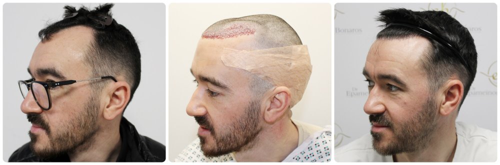 dr-bonaros-hair-transplant-glasgow-result (34) (1).jpg