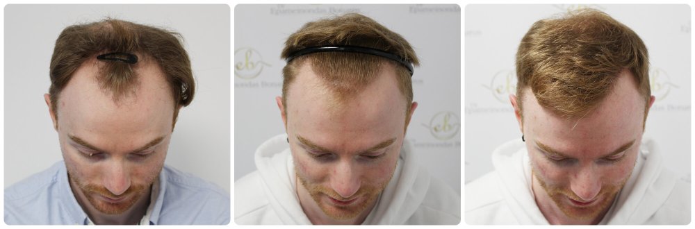 dr-bonaros-hair-transplant-glasgow-result (4).jpg