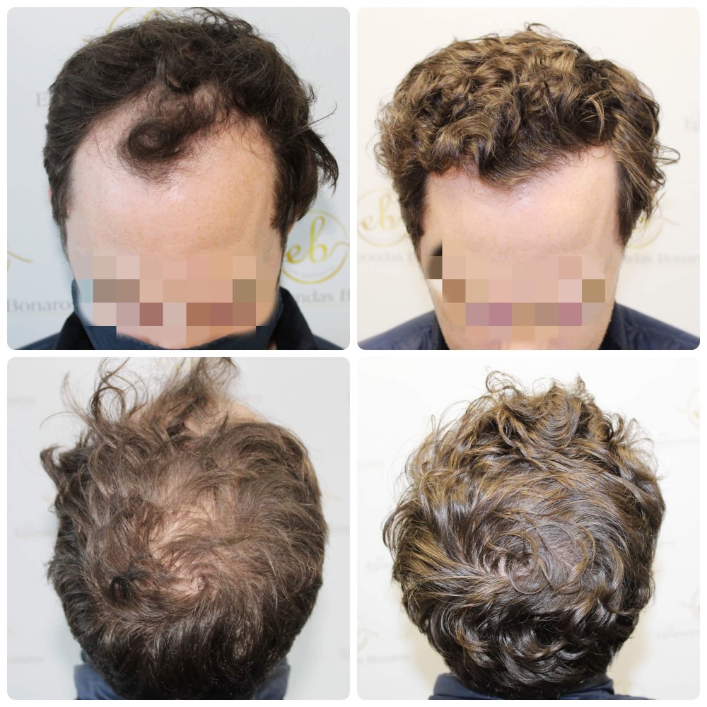 dr-bonaros-hair-transplant-glasgow-result (8) (1).jpg