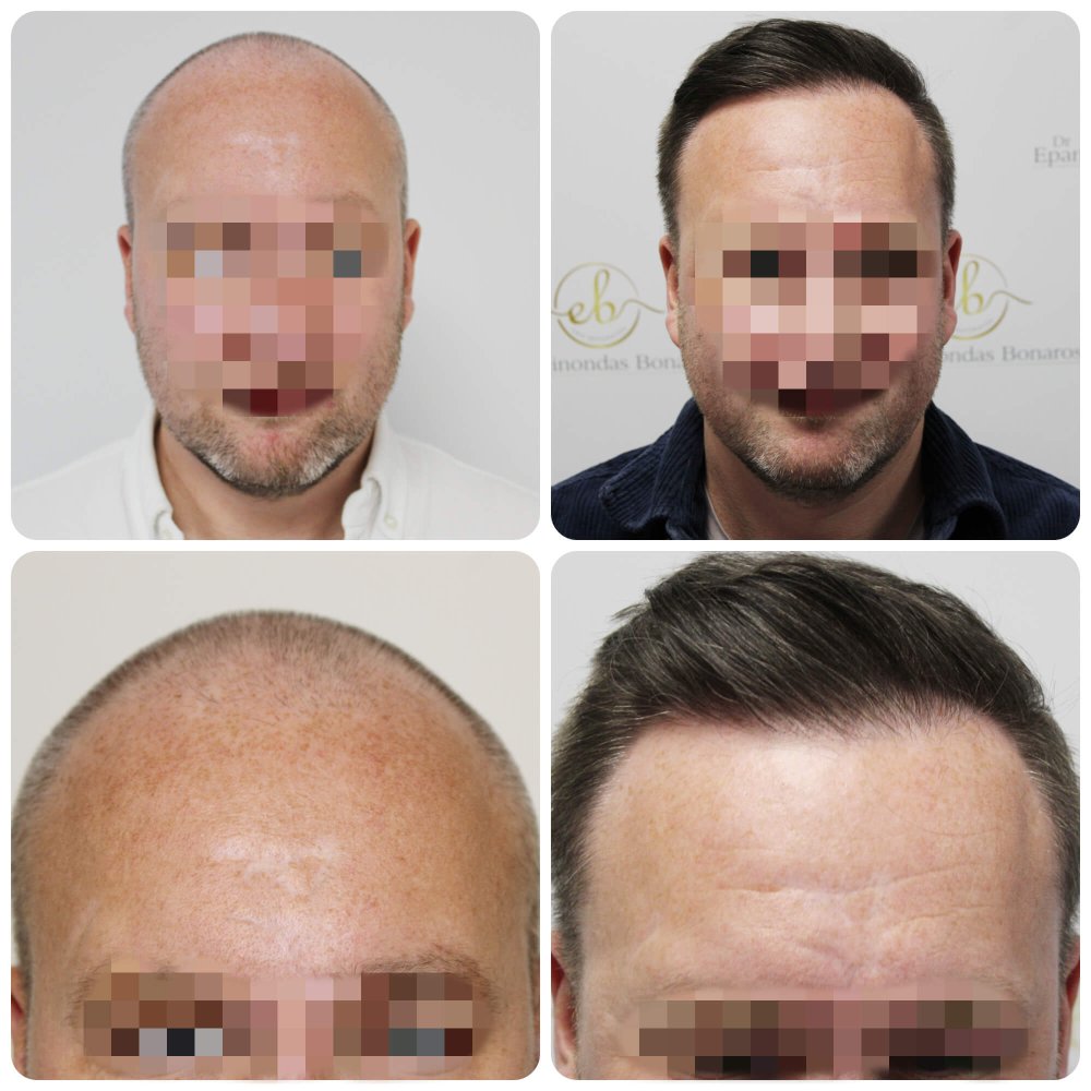 dr-bonaros-hair-transplant-glasgow-result (9) (1).jpg