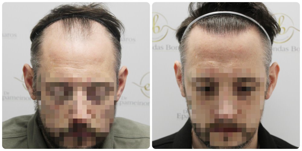 dr-bonaros-hair-transplant-glasgow-result (9) (1).jpg