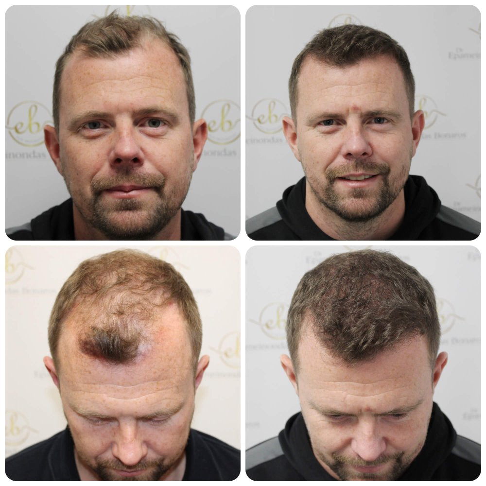 dr-bonaros-hair-transplant-glasgow-result (9).jpg