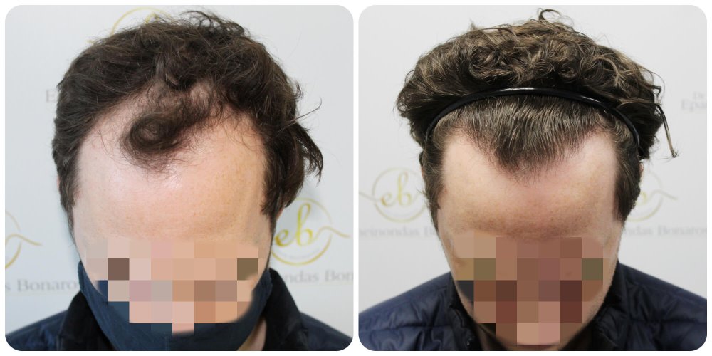 dr-bonaros-hair-transplant-glasgow-result .jpg
