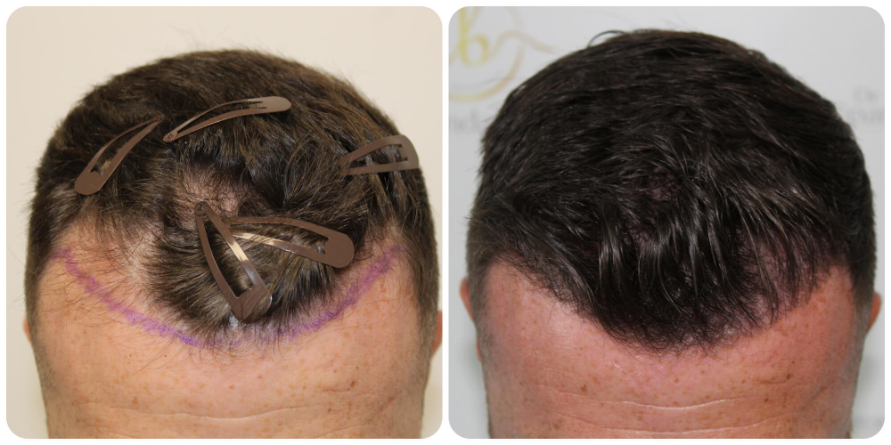 dr-bonaros-hair-transplant-result-glasgow-.png