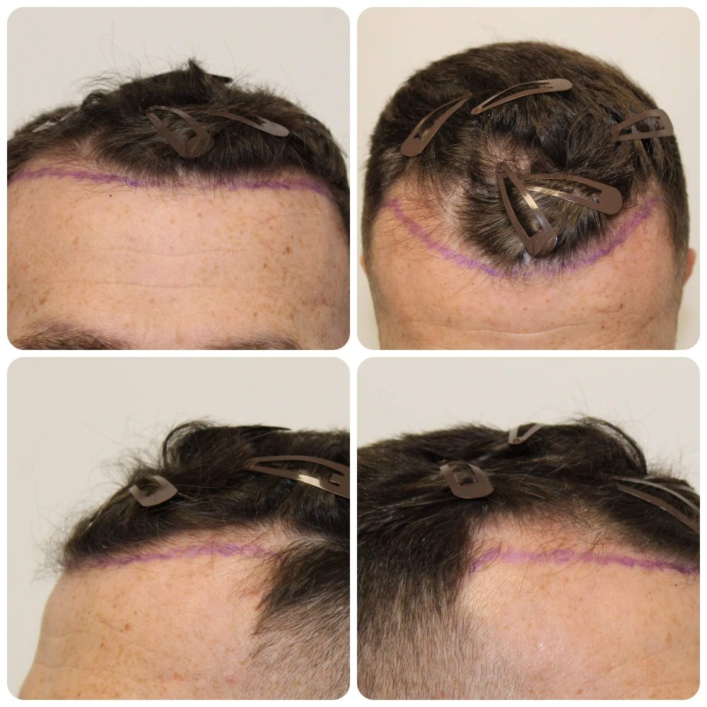 dr-bonaros-hair-transplant-scotland.jpg
