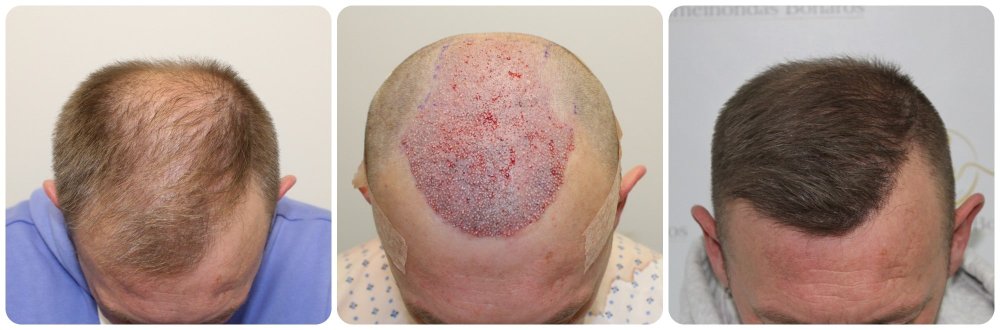 dr-bonaros-scotland-hairline-fue-transplant.jpg