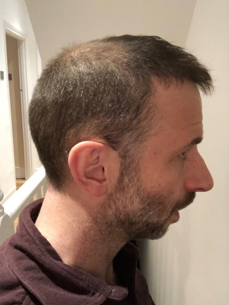 Dr Christina Vryonidou, MD - HDC - Hair Transplant10.jpg