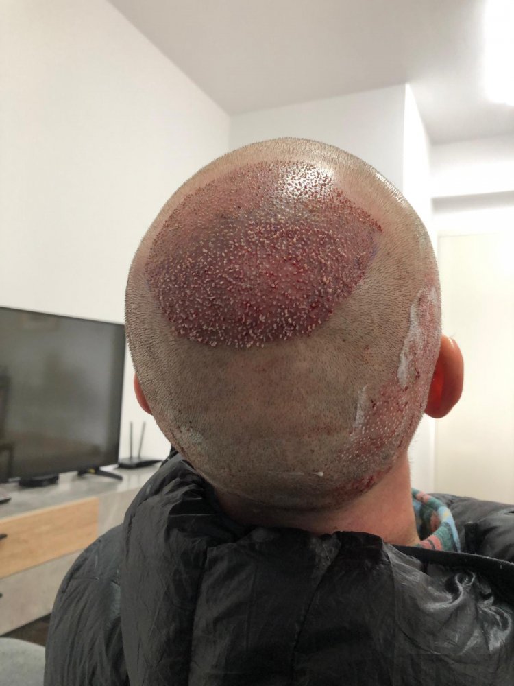 Dr Christina Vryonidou, MD - HDC - Hair Transplant11.jpg