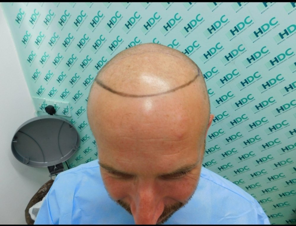 Dr Christina Vryonidou, MD - HDC - Hair Transplant2.jpg