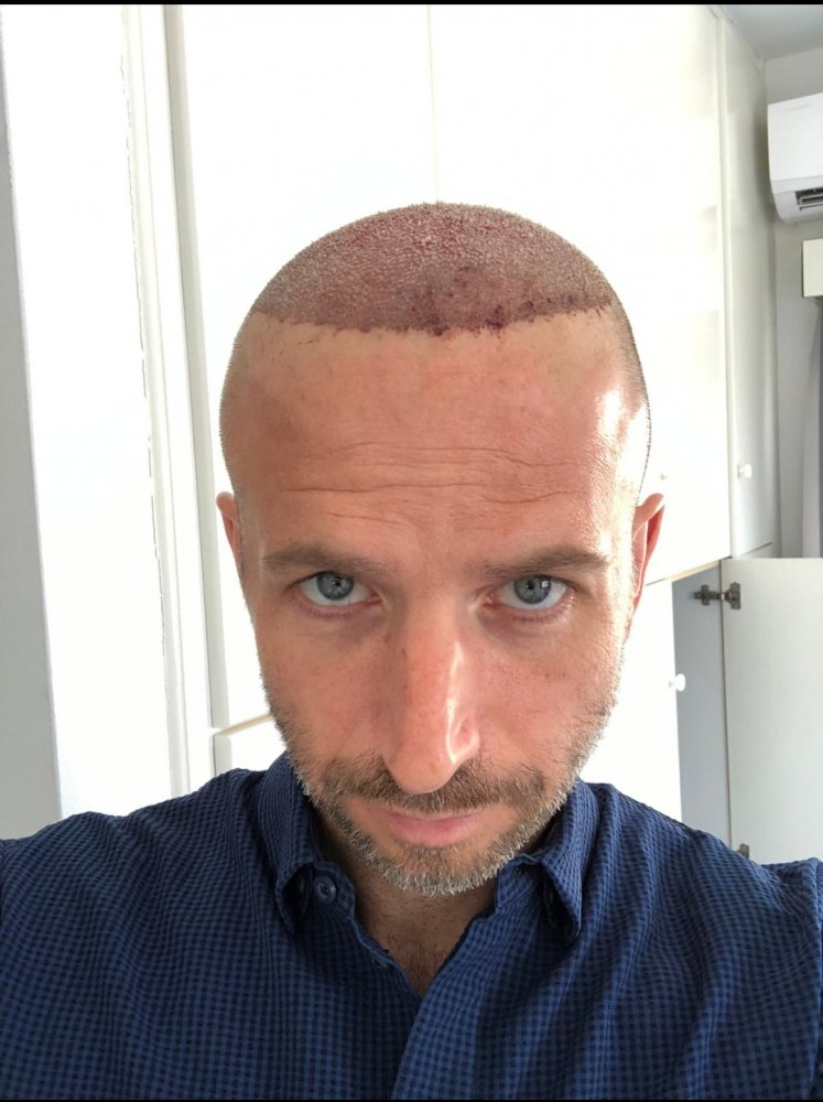 Dr Christina Vryonidou, MD - HDC - Hair Transplant4.jpg