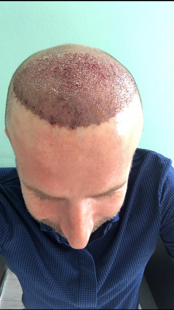 Dr Christina Vryonidou, MD - HDC - Hair Transplant5.jpg