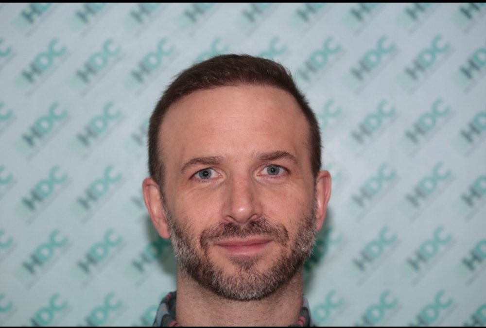 Dr Christina Vryonidou, MD - HDC - Hair Transplant6.jpg