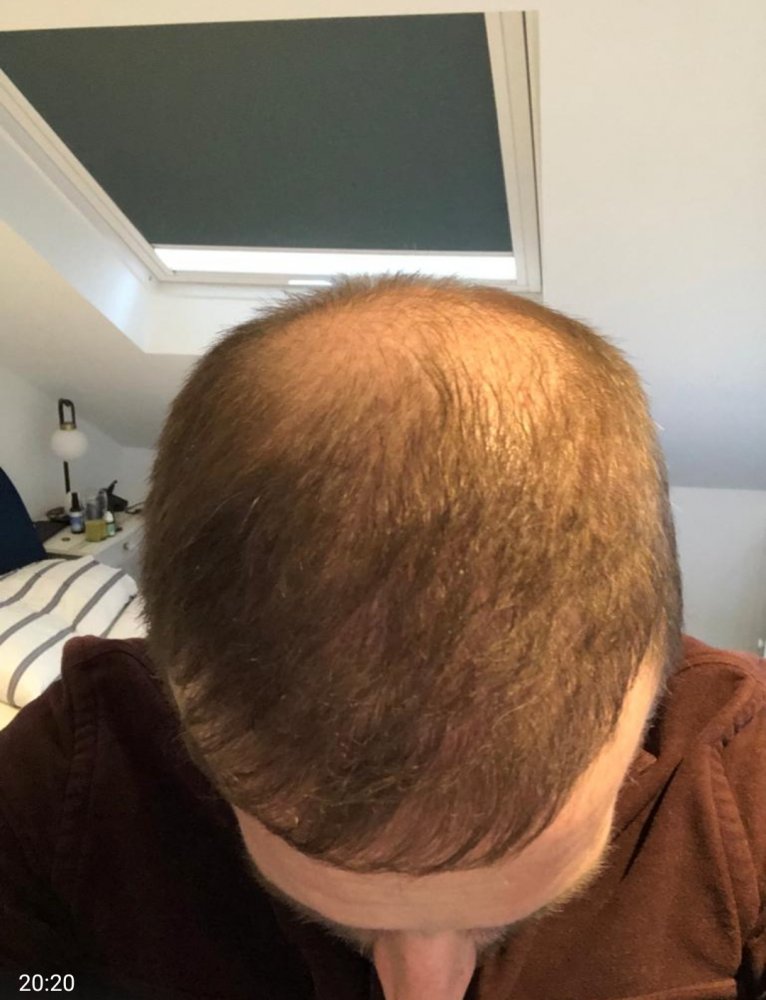 Dr Christina Vryonidou, MD - HDC - Hair Transplant7.jpg