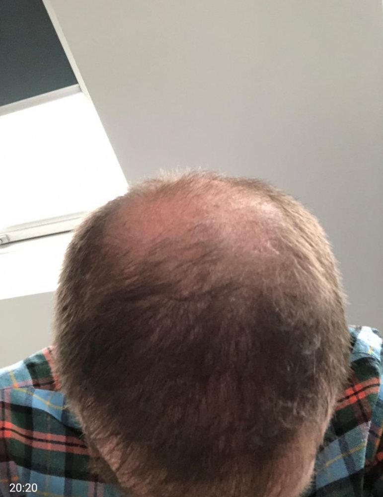 Dr Christina Vryonidou, MD - HDC - Hair Transplant8.jpg