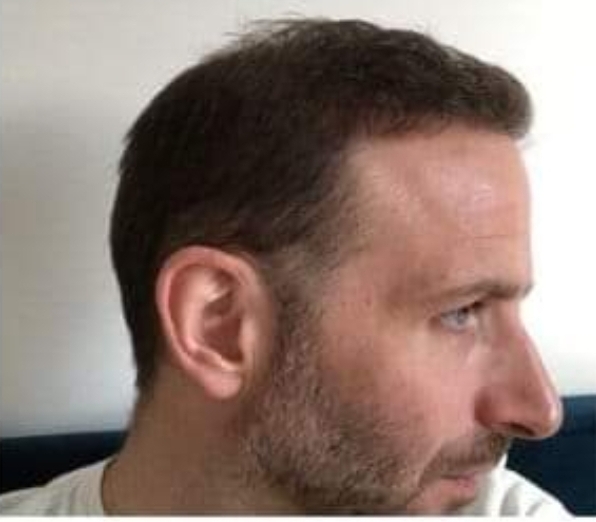 Dr Christina Vryonidou, MD - HDC - Hair Transplant9.jpg