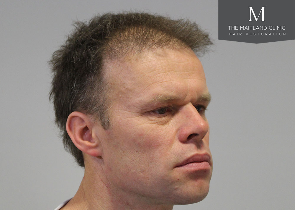 Dr. Edward Ball hair transplant result 1.jpg