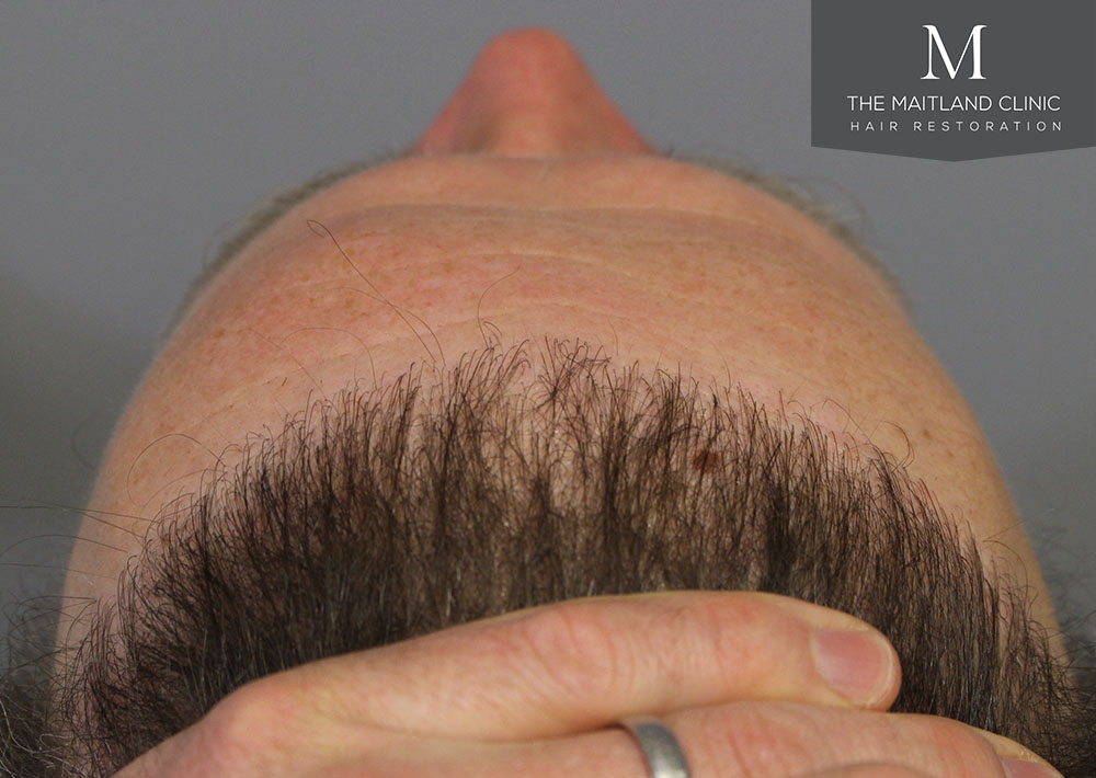 Dr. Edward Ball hair transplant result 7.jpg