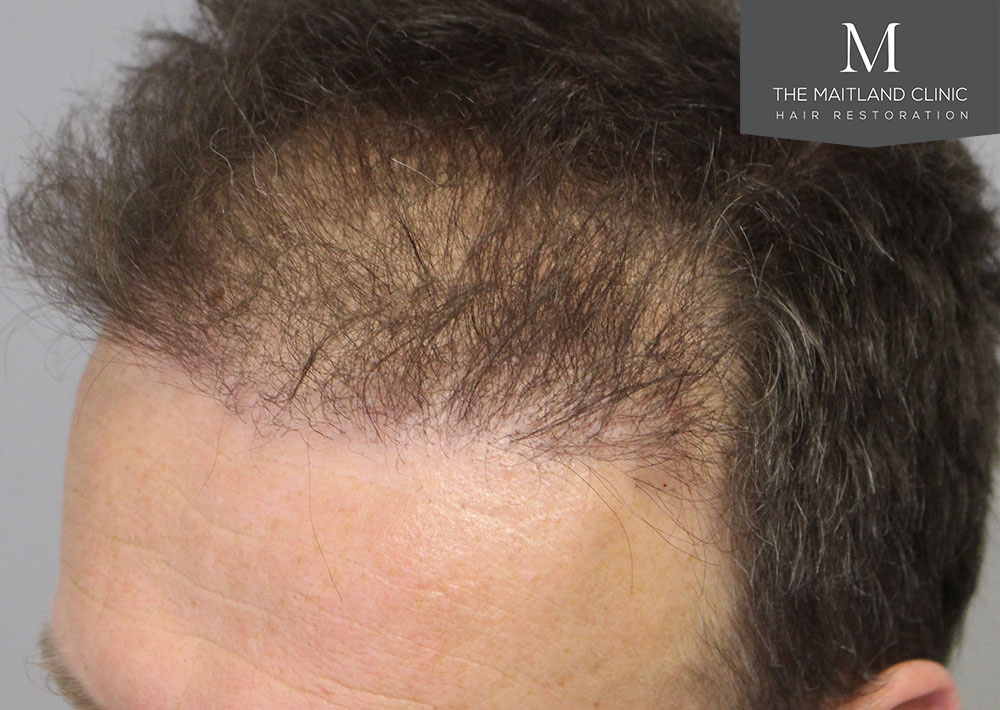 Dr. Edward Ball hair transplant result 9.jpg