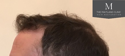 Dr Edward Maitland Ball  Hair Transplant 10.jpg
