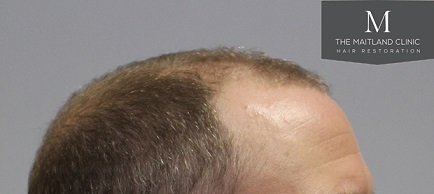 Dr Edward Maitland Ball  Hair Transplant 11.jpg