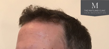 Dr Edward Maitland Ball  Hair Transplant 12.jpg