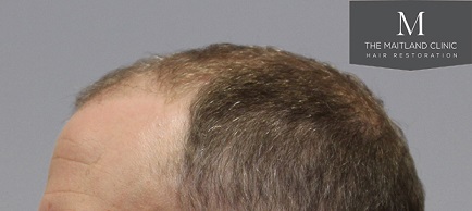Dr Edward Maitland Ball  Hair Transplant 13.jpg