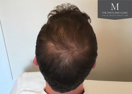 Dr Edward Maitland Ball  Hair Transplant 2.jpg
