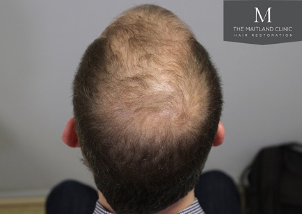 Dr Edward Maitland Ball  Hair Transplant 3.jpg