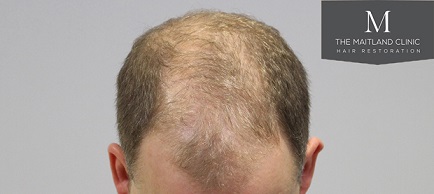 Dr Edward Maitland Ball  Hair Transplant 4.jpg
