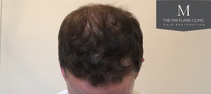 Dr Edward Maitland Ball  Hair Transplant 5.jpg