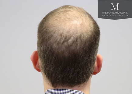 Dr Edward Maitland Ball  Hair Transplant 6.jpg