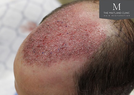 Dr Edward Maitland Ball  Hair Transplant 8.jpg