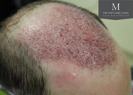 Dr Edward Maitland Ball  Hair Transplant 9.jpg