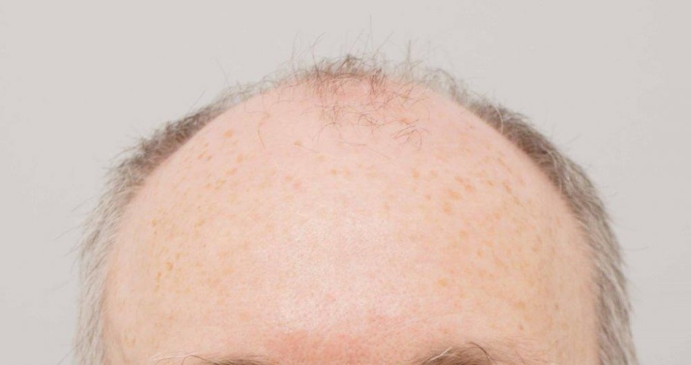 Dr Farjo FUE + FUT Hair Transplant1.jpg
