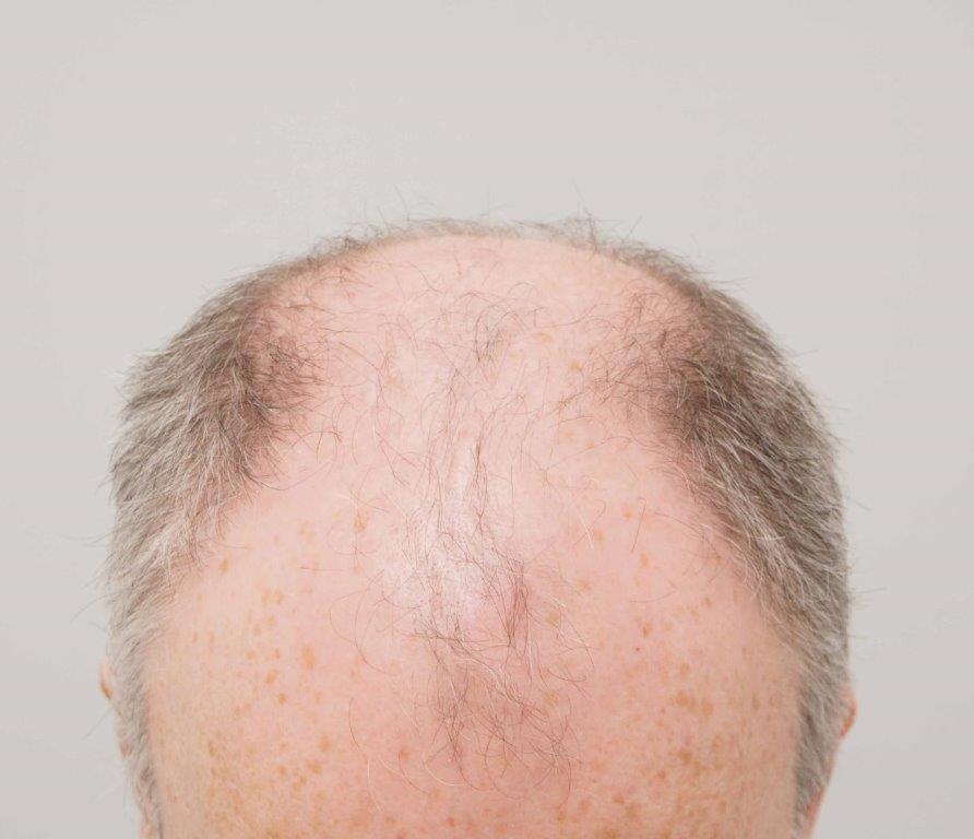 Dr Farjo FUE + FUT Hair Transplant2.jpg