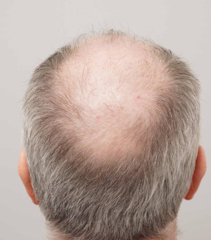 Dr Farjo FUE + FUT Hair Transplant3.jpg