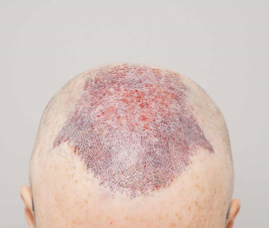 Dr Farjo FUE + FUT Hair Transplant4.jpg