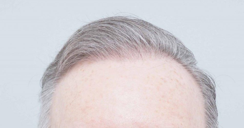 Dr Farjo FUE + FUT Hair Transplant5.jpg