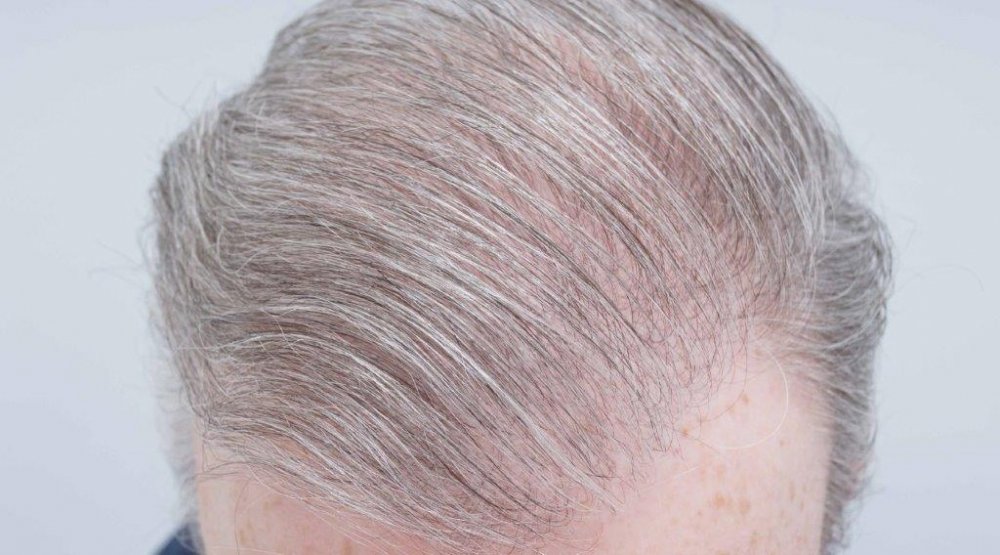 Dr Farjo FUE + FUT Hair Transplant6.jpg