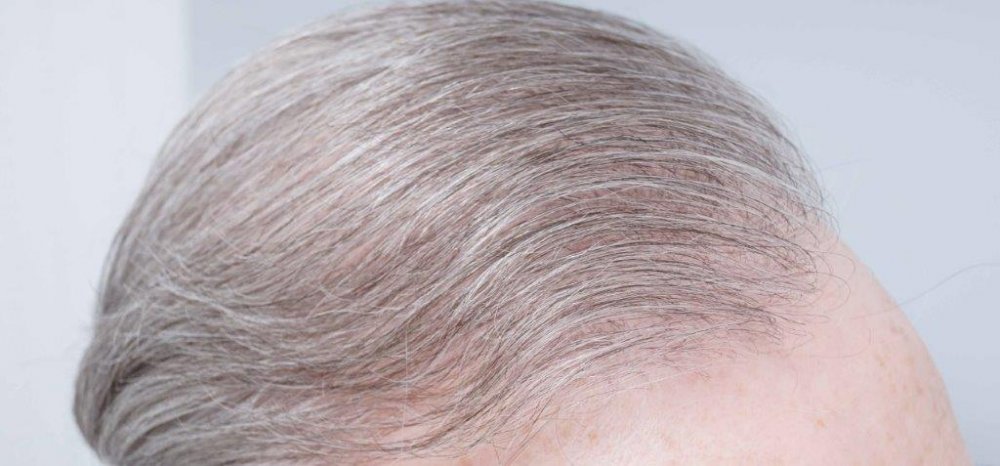 Dr Farjo FUE + FUT Hair Transplant7.jpg