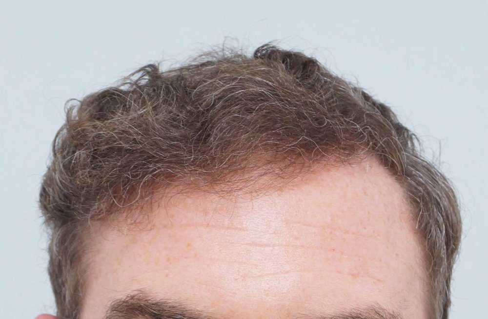Dr Farjo hair transplant 1.jpg