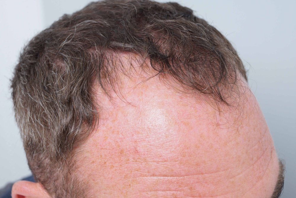Dr Farjo hair transplant 10.jpg