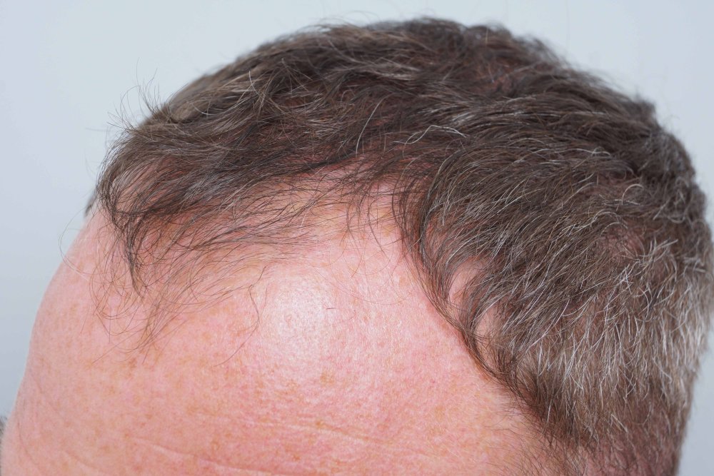 Dr Farjo hair transplant 11.jpg