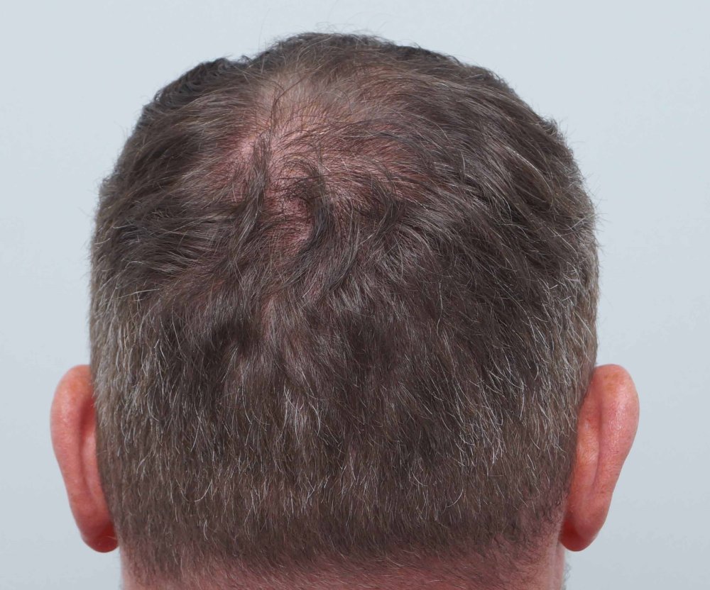 Dr Farjo hair transplant 12.jpg