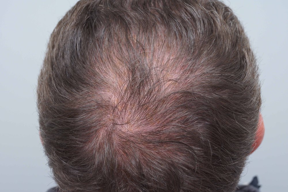 Dr Farjo hair transplant 13.jpg